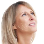 Hilos tensores Pack Soft 20+4 (Rostro)