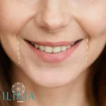 Líneas de Marioneta - Ácido Hialurónico Ilikia