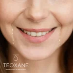 Líneas de Marioneta - Ácido Hialurónico Teoxane