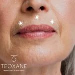 Código de Barra o Perilabial - Ácido Hialurónico Teoxane