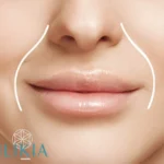 Surco Nasogeniano - Ácido Hialurónico Ilikia