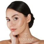 Relleno de Pómulos - Ácido Hialurónico (1ml) Teoxane