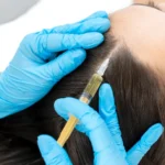 Plasma Rico en Plaquetas Capilar - 1 Sesión a 3 Sesiones