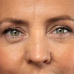 Polinucléotidos Periocular - Nucleofill Soft Plus - 1 a 4 Sesiones