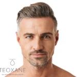 Masculinización Facial - Ácido Hialurónico Teoxane