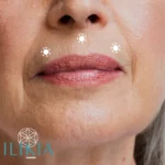 Código de Barra o Perilabial - Ácido Hialurónico Ilikia