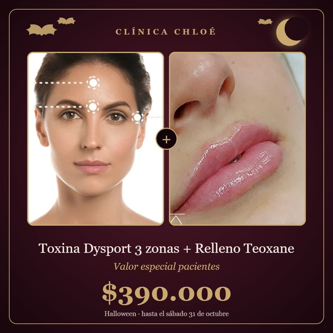Pack Toxina Dysport 3 zonas + Relleno Teoxane 1 zona – Valor especial pacientes